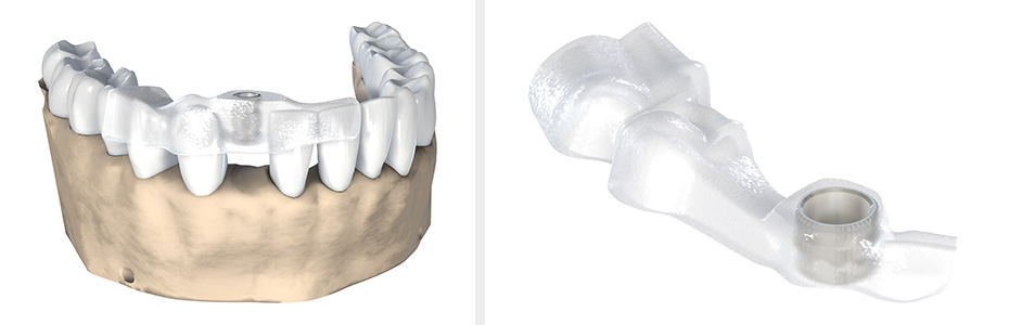 Schablonen auf Grundlage der 3D-Planung ermöglichen eine genaue Platzierung des Implantates.